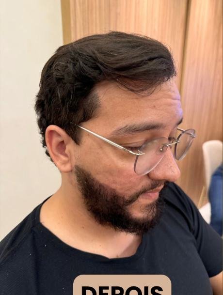 Depois do transplante capilar