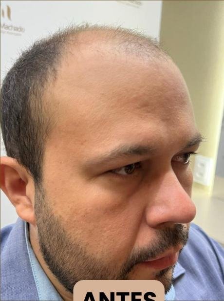 Antes do transplante capilar