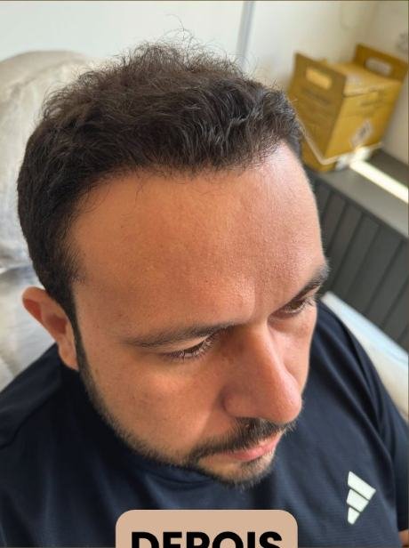 Depois do transplante capilar