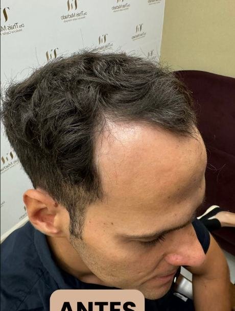 Antes do transplante capilar