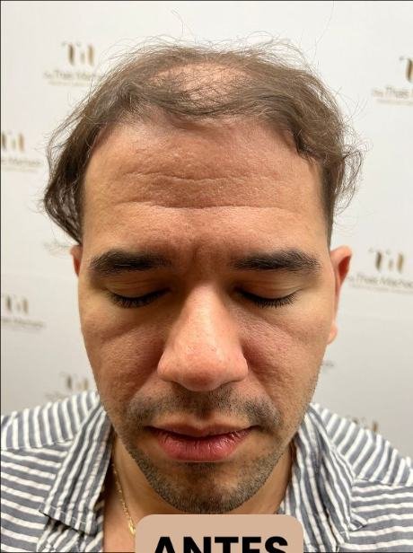 Antes do transplante capilar