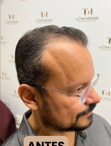 Antes do transplante capilar