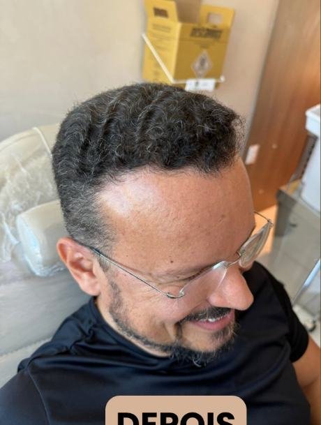 Depois do transplante capilar