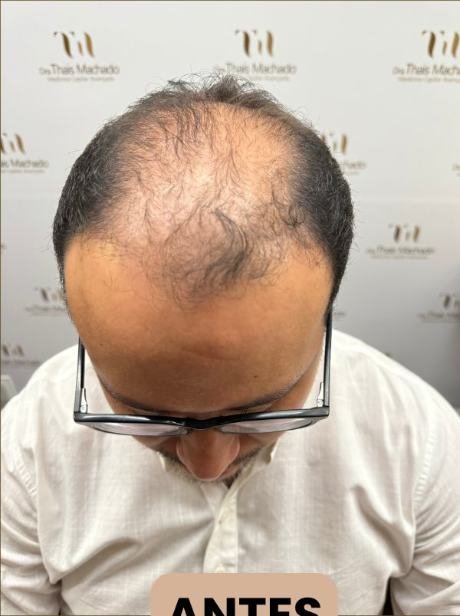 Antes do transplante capilar