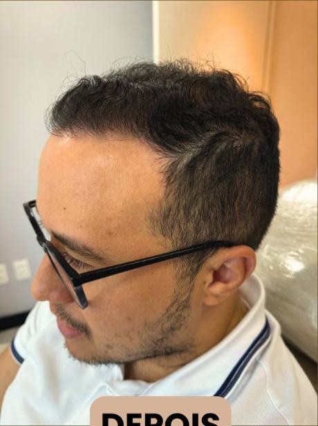 Depois do transplante capilar