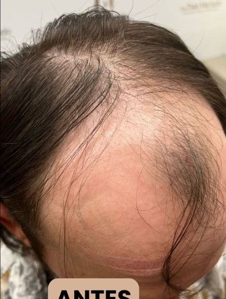 Antes do transplante capilar