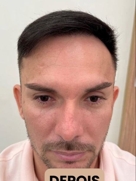 Depois do transplante capilar