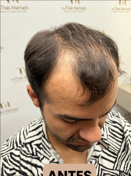 Antes do transplante capilar