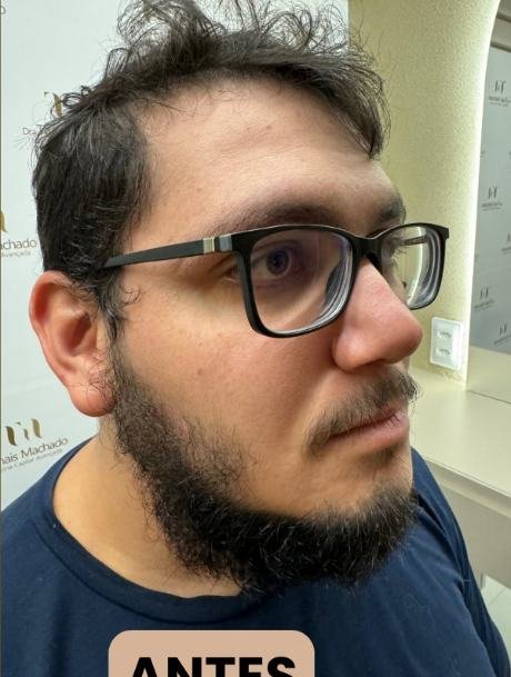 Antes do transplante capilar