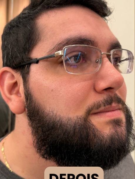 Depois do transplante capilar