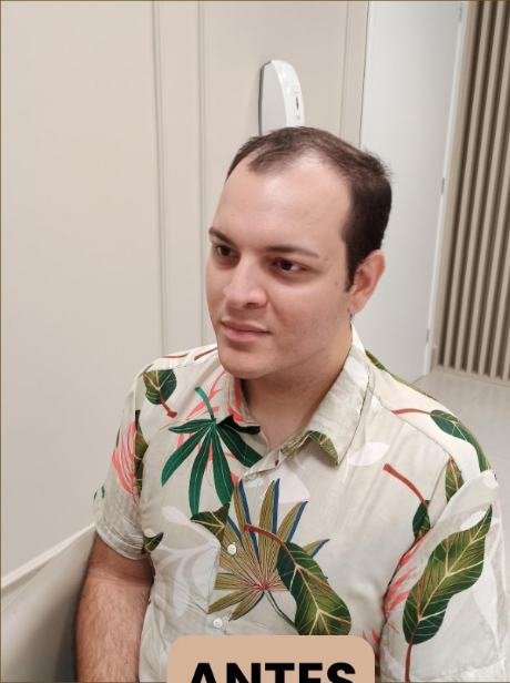Antes do transplante capilar