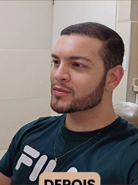 Depois do transplante capilar