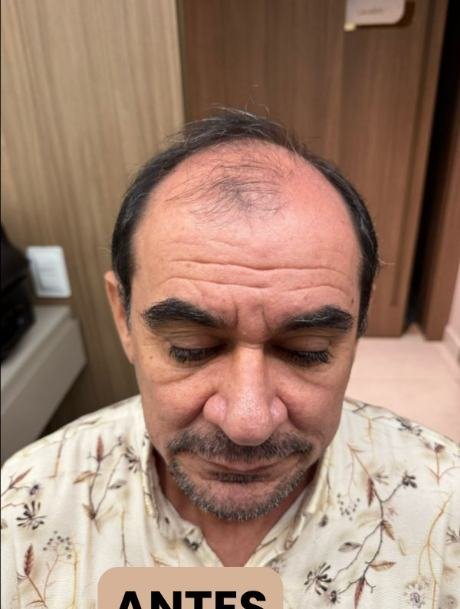 Antes do transplante capilar