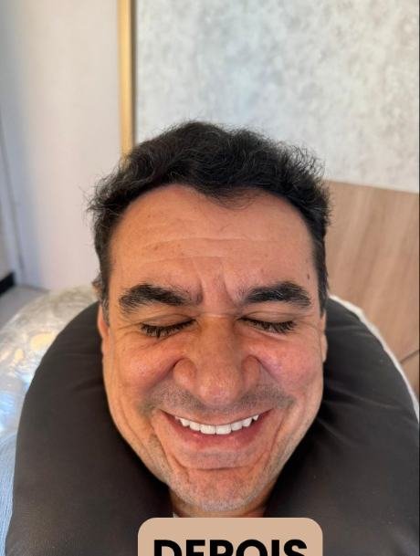 Depois do transplante capilar