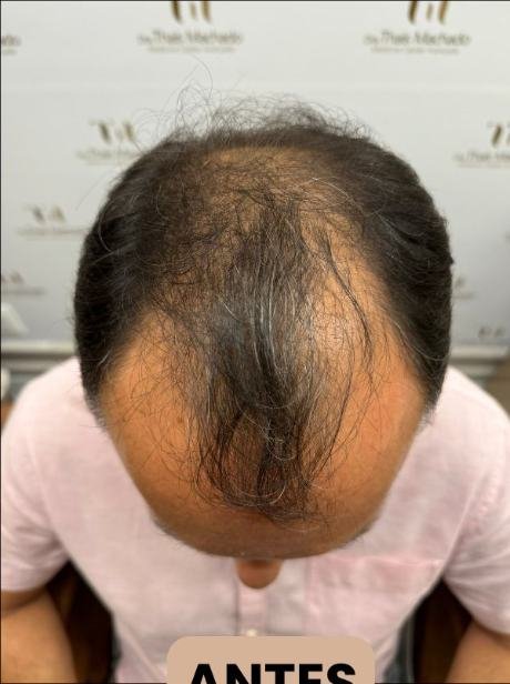 Antes do transplante capilar