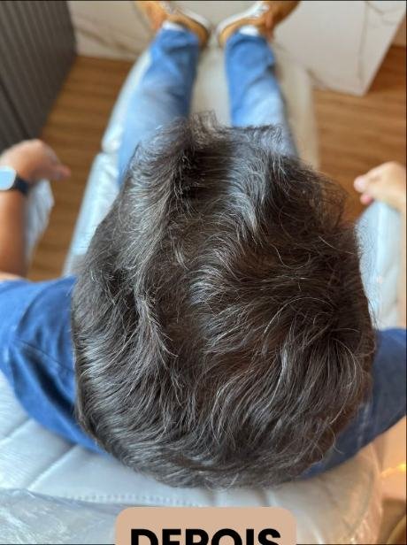 Depois do transplante capilar