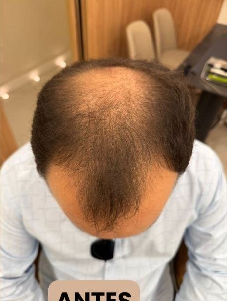 Antes do transplante capilar