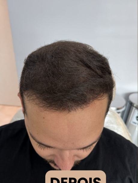 Depois do transplante capilar