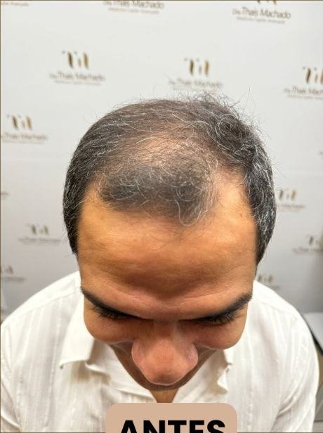 Antes do transplante capilar