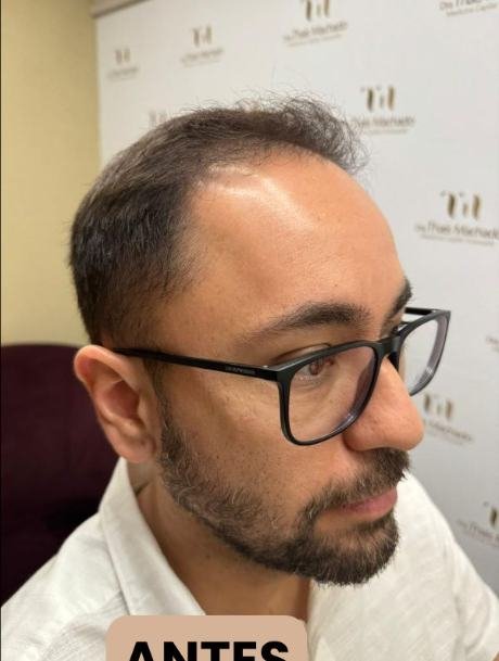 Antes do transplante capilar