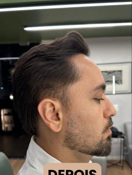 Depois do transplante capilar