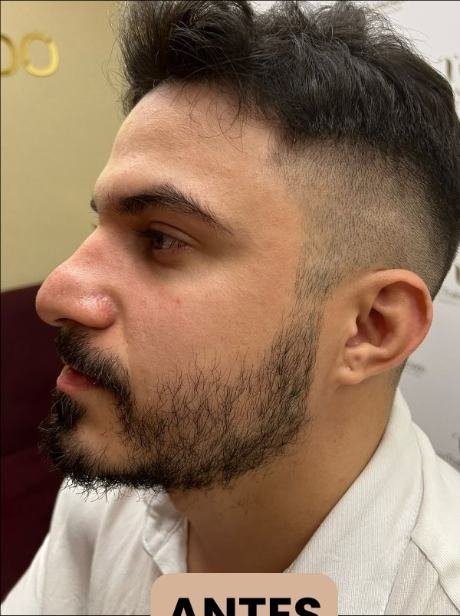 Antes do transplante capilar