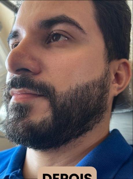 Depois do transplante capilar