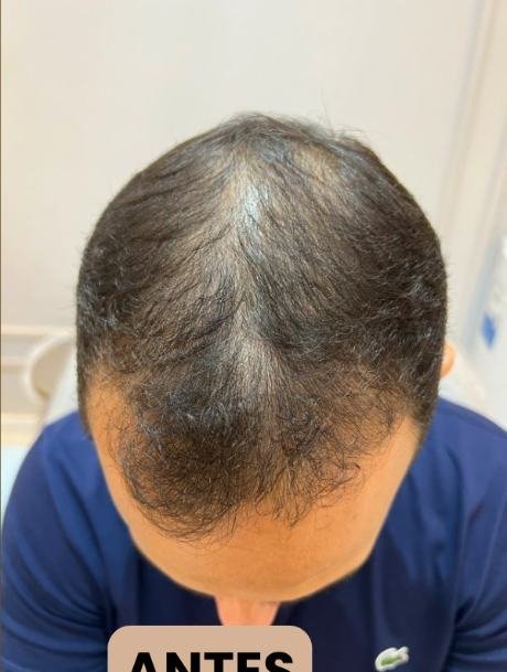 Antes do transplante capilar