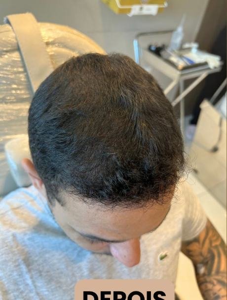 Depois do transplante capilar