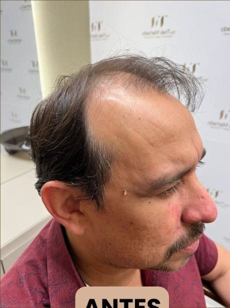 Antes do transplante capilar