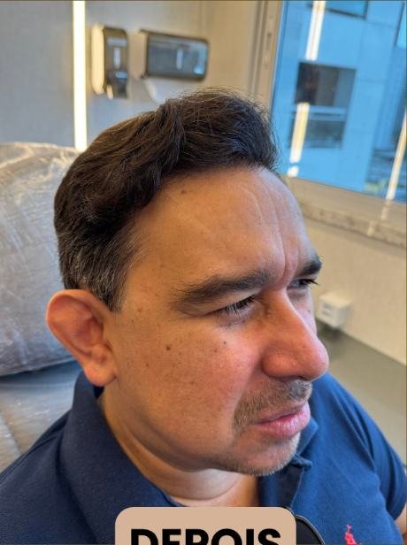 Depois do transplante capilar