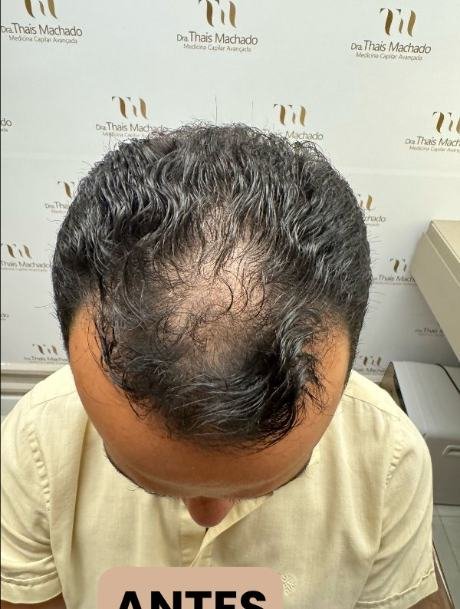 Antes do transplante capilar