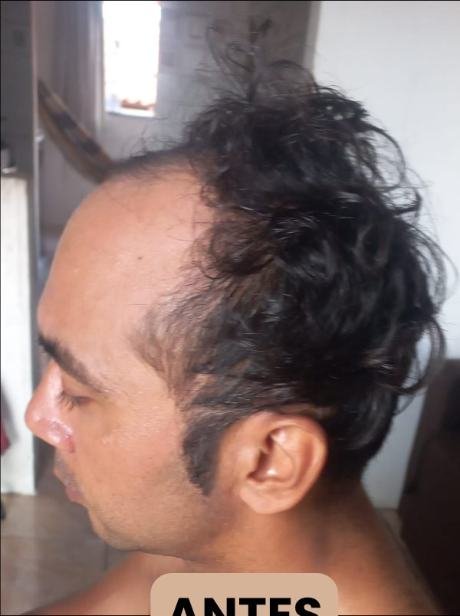 Antes do transplante capilar