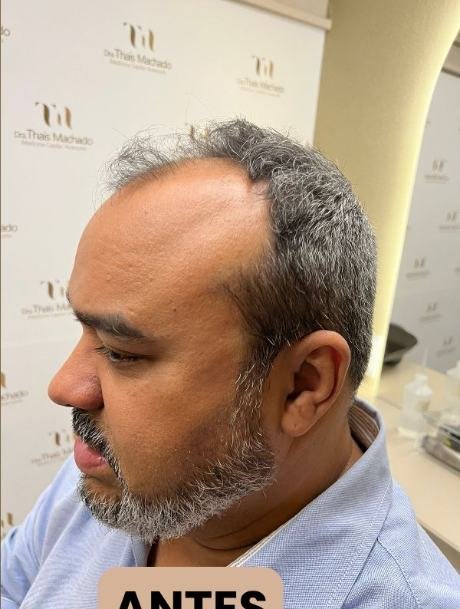 Antes do transplante capilar