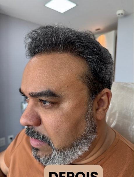 Depois do transplante capilar