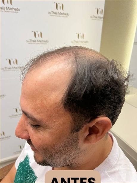Antes do transplante capilar