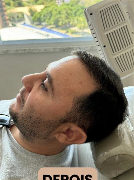 Depois do transplante capilar