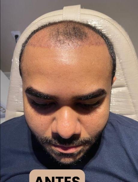 Antes do transplante capilar