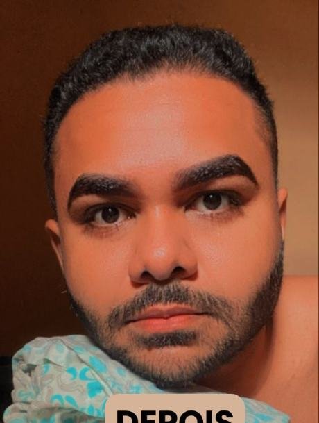 Depois do transplante capilar