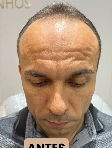 Antes do transplante capilar