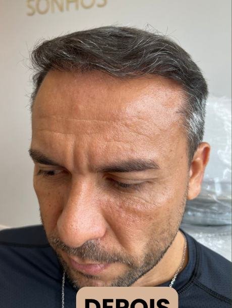 Depois do transplante capilar