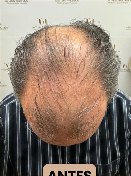 Antes do transplante capilar