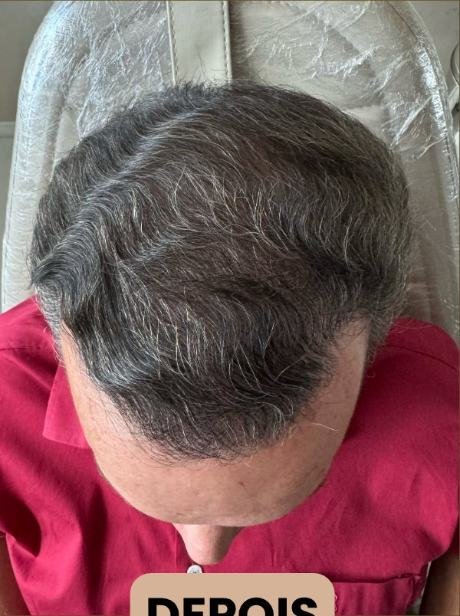 Depois do transplante capilar