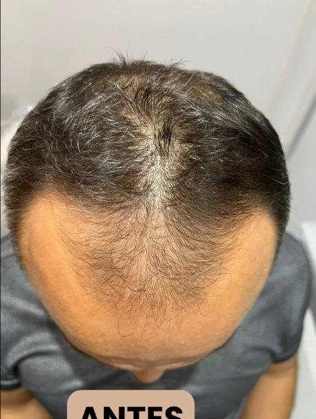 Antes do transplante capilar