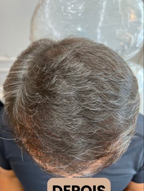 Depois do transplante capilar