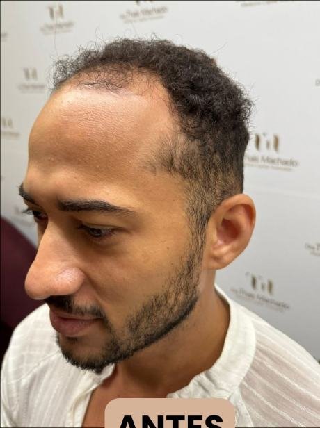 Antes do transplante capilar