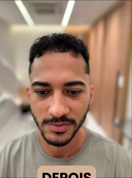 Depois do transplante capilar