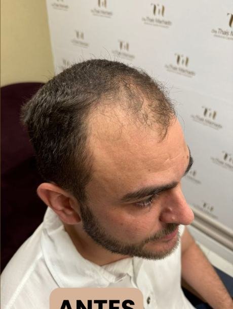Antes do transplante capilar