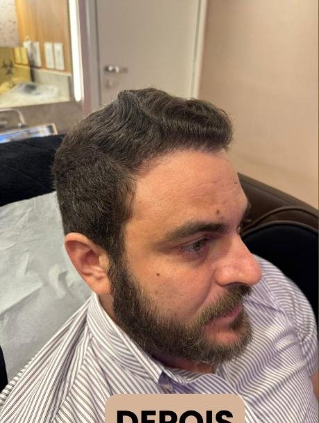 Depois do transplante capilar