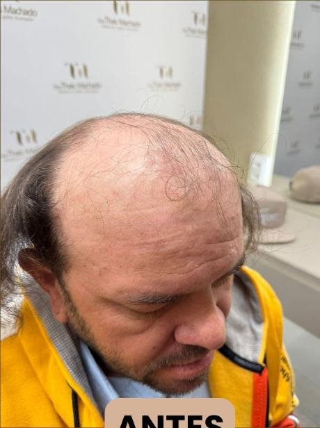 Antes do transplante capilar